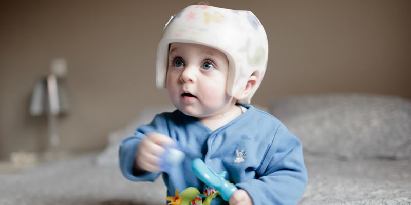 Plagiocephaly